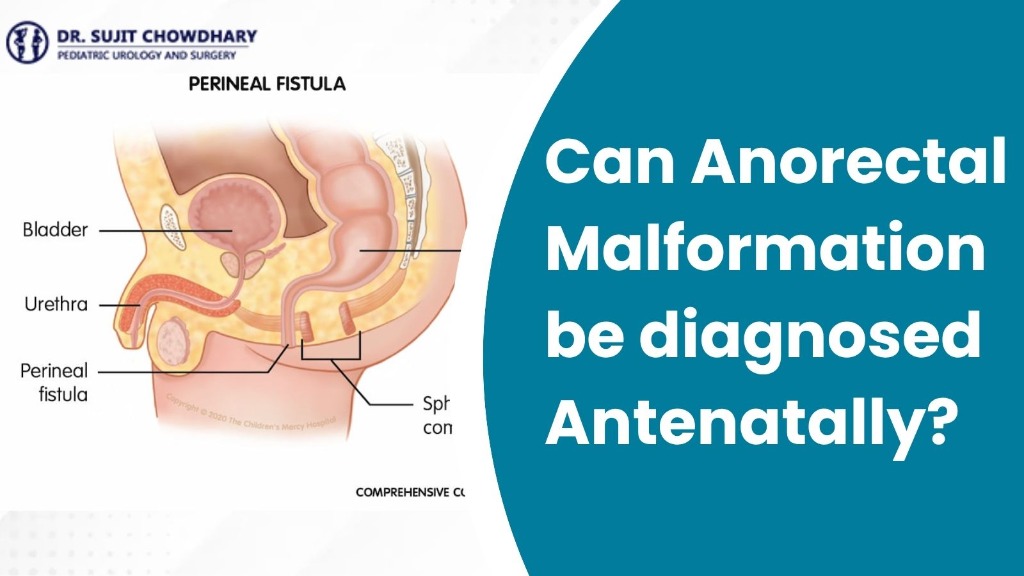 Can Anorectal Malformation be diagnosed Antenatally?